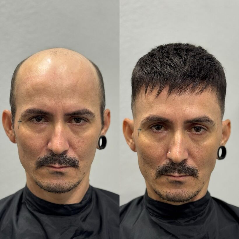 Comparação entre prótese capilar e transplante capilar