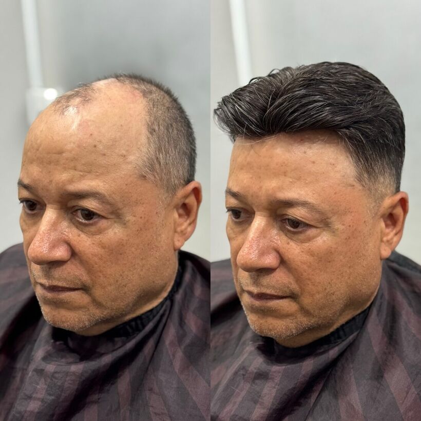 Quanto custa a prótese capilar na VG em Americana-SP