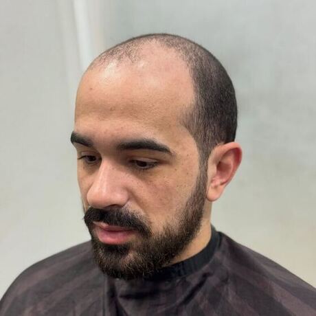Antes da prótese capilar - frente