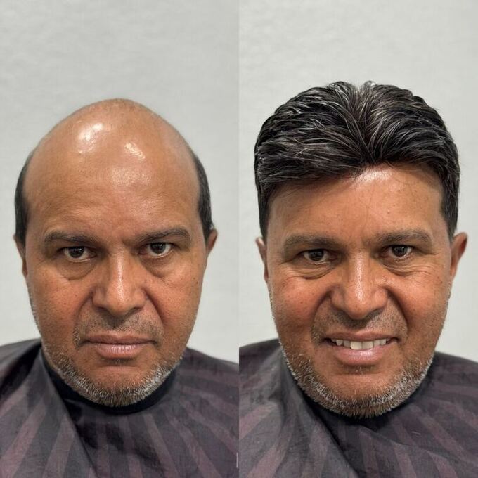 Antes e depois de prótese capilar masculina em Americana-SP