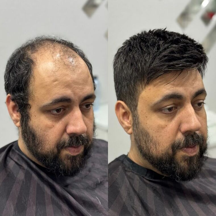 Antes e depois de prótese capilar natural