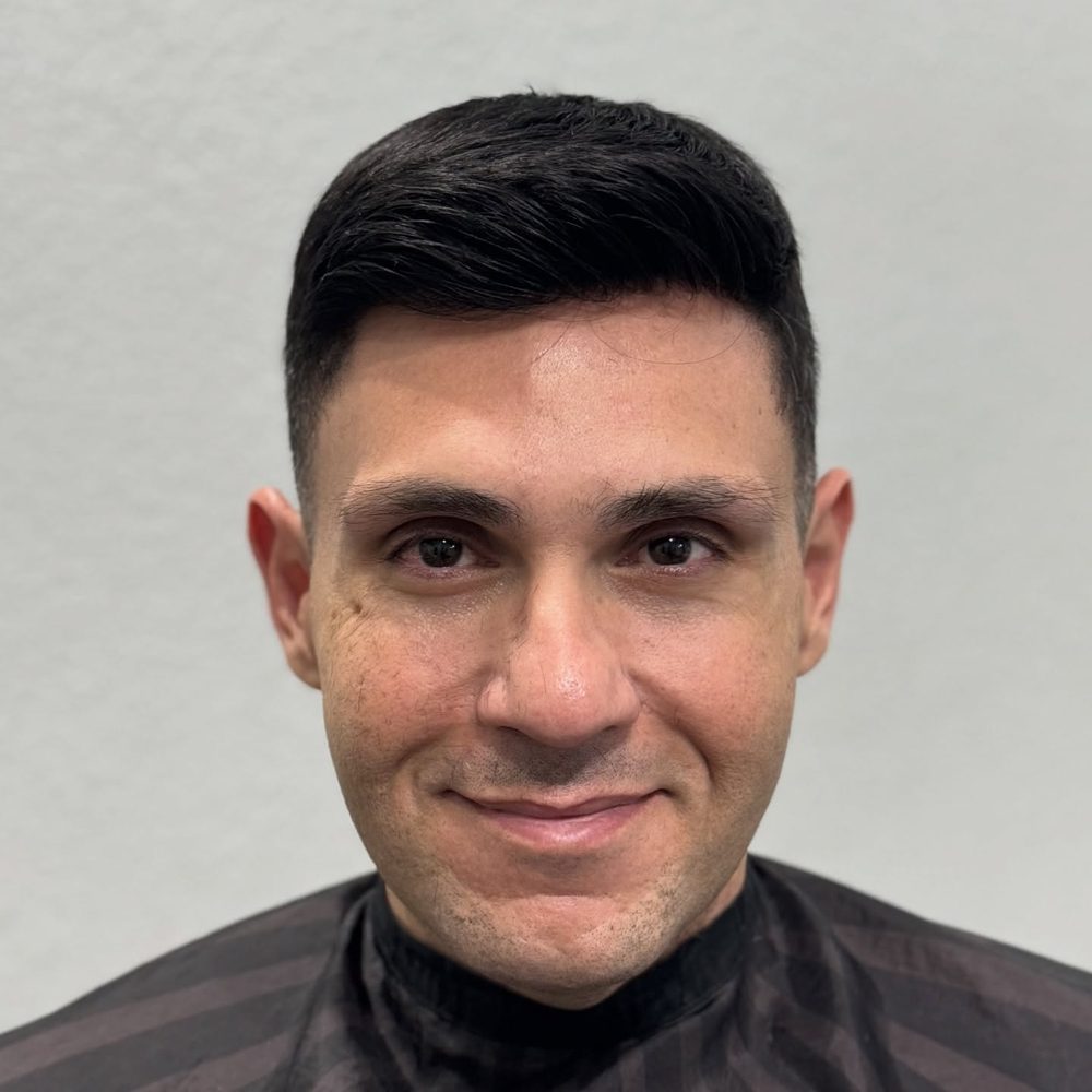 Resultado natural de prótese capilar masculina
