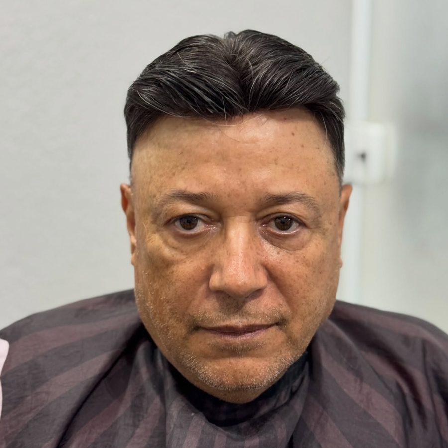 Resultado natural de prótese capilar masculina