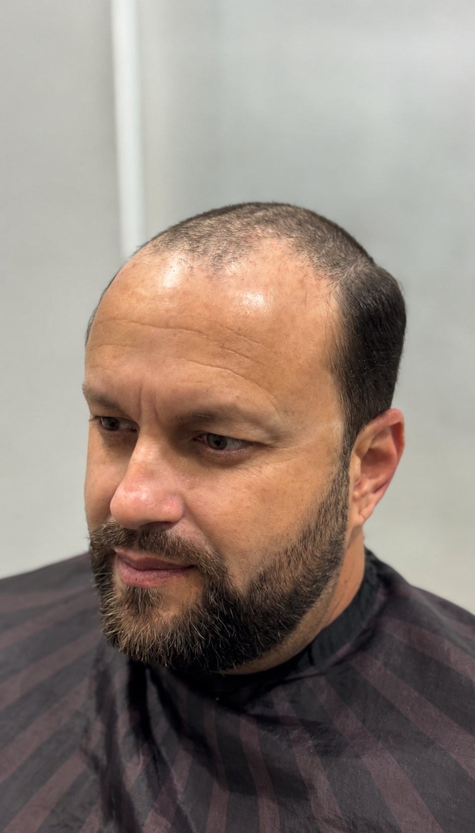 Antes da prótese capilar - couro cabeludo com falha e perda de densidade