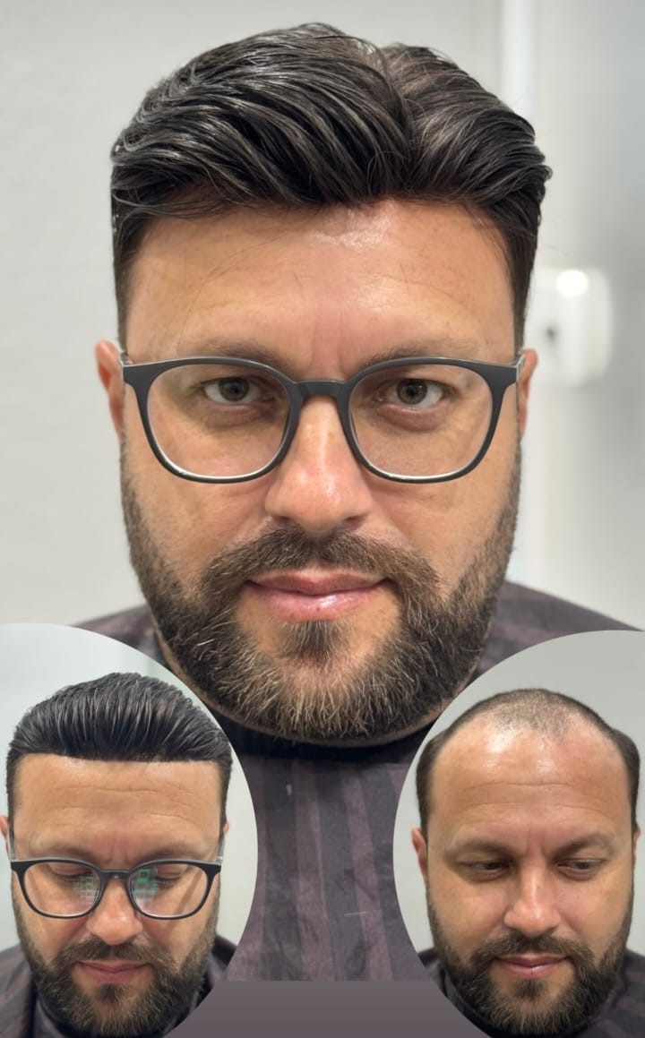 Produtos capilares para calvície