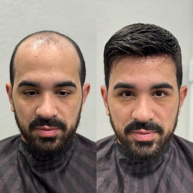 Prótese capilar masculina de alta qualidade